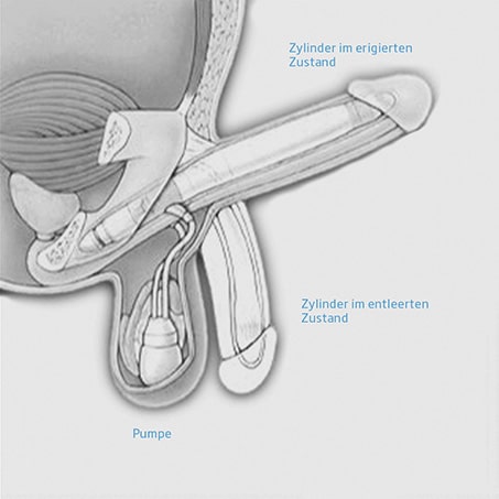 IPP Behandlung - Penisprothese AMS