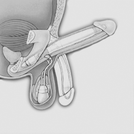 Penisprothese
